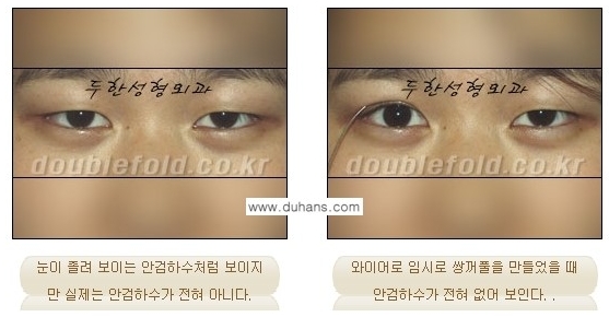 [두한성형외과 경쟁력 눈성형] - [안검하수(졸리운 눈매)의 종류와 교정 방법 안내] 관련 이미지 5