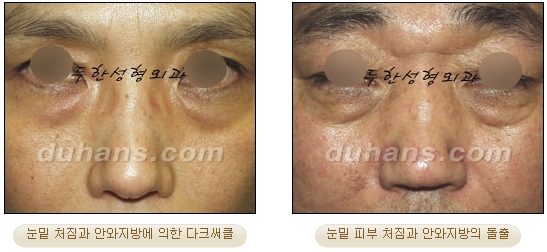 [Duhan Plastic Surgery Ophthalmic Plastic Surgery] - [Lower Blepharoplasty] image 2