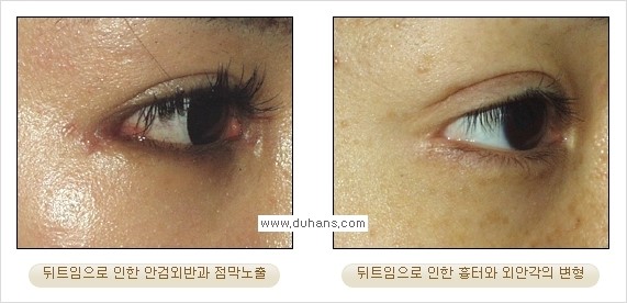 [두한성형외과 경쟁력 쌍꺼풀 재수술, 극한 눈재수술] - [뒤트임 수술의 부작용 안내] 관련 이미지 9