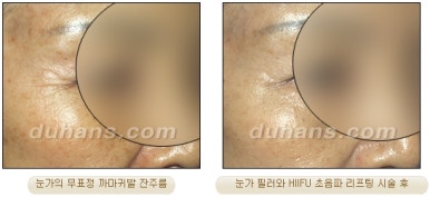 두한성형외과 주름개선 - 주름 HIFU 리프팅 관련 이미지 26