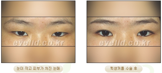 [Duhan Plastic Surgery Eye Surgery] - [First Double Eyelid Surgery] image 16
