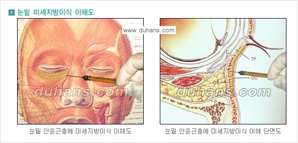 [두한성형외과 경쟁력 미세지방이식] - [다크써클 & 눈밑주름 미세지방이식 2.] 관련 이미지 6