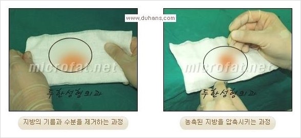 [두한성형외과 경쟁력 미세지방이식] - [관자놀이(측두부) 지방이식] 관련 이미지 4