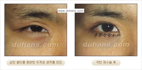 ⁠⁠⁠⁠[두한성형외과 성형 FOCUS] - [정상적인 눈매로의 복원 극한재수술 경우 ①] 관련 이미지 11