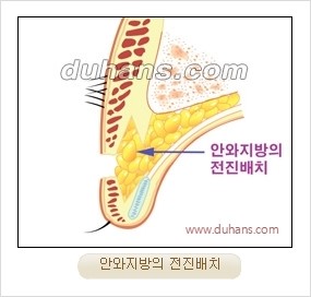 [두한성형외과 경쟁력 눈성형] - [완전절개법(Full incision method)의 재수술 과정] 관련 이미지 4