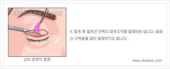 [두한성형외과 경쟁력 눈성형] - [상큼하고 환한 눈매! 상안검 성형(윗눈꺼풀 처짐) 안내] 관련 이미지 4