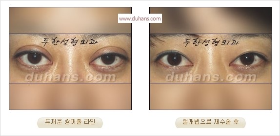 [두한성형외과 경쟁력 눈성형] - [나에게 맞는 어울리는 쌍꺼풀 라인] 관련 이미지 7