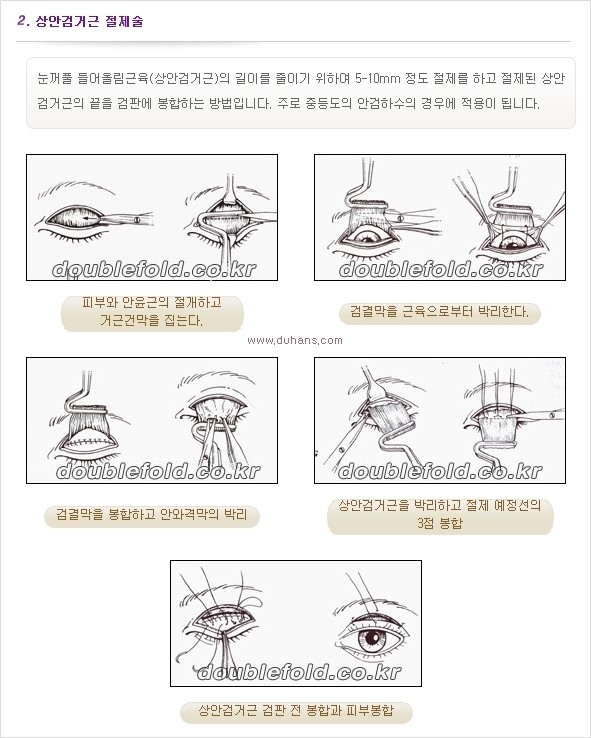 [두한성형외과 경쟁력 쌍꺼풀 재수술, 극한 눈재수술] - [안검하수 검사 및 수술방법 안내] 관련 이미지 7