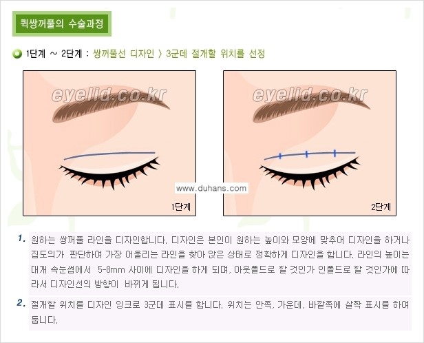 [두한성형외과 성형 FOCUS] - [퀵쌍꺼풀 수술 ③] 관련 이미지 6