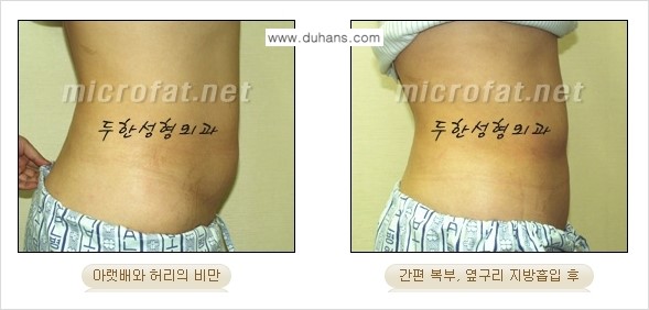 [두한성형외과 겨울엔 지방흡입] - [간편한 복부지방흡입 도전 2.] 관련 이미지 10