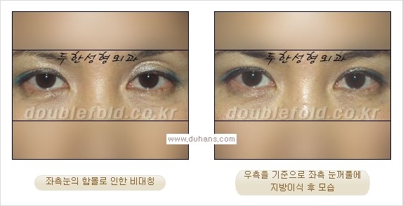 ​⁠⁠[두한성형외과 경쟁력 쌍꺼풀 재수술, 극한 눈재수술] - [지방이식으로 눈매와 쌍꺼풀 라인을 교정] 관련 이미지 14