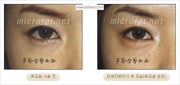 ​﻿[두한성형외과 경쟁력 지방이식] - [눈밑 애교살 시술을 위한 미세지방이식] 관련 이미지 24