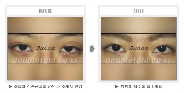 [두한성형외과 경쟁력 눈성형] - [삼중(세겹) 쌍꺼풀 라인의 교정] 관련 이미지 10