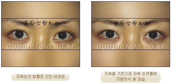 [Eye Reoperation Duhan Plastic Surgery] - [Guide to Double Eyelid Revision Surgery] image 55