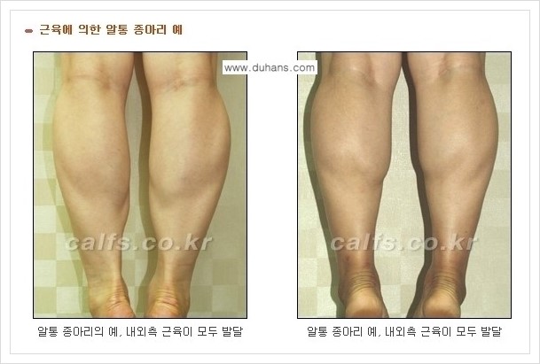 [두한성형외과 경쟁력 멀티종아리성형] - [나에게 맞는 종아리 시술 방법과 종류 안내 ①] 관련 이미지 3
