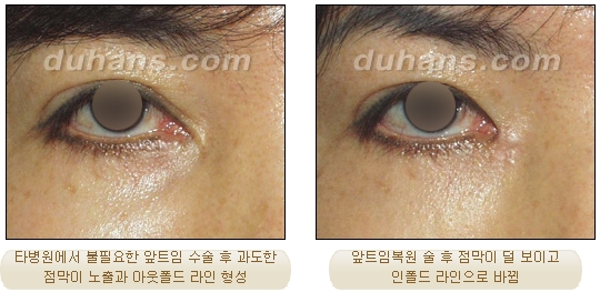 [Duhan Plastic Surgery Double Eyelid Revision] - [Inner Corner Revision, Outer Corner Revision] image 2