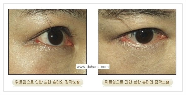 [두한성형외과 경쟁력 있는 쌍꺼풀 재수술] - [뒤트임 수술] 관련 이미지 13