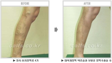[종아리 두한성형외과] - [나에게 맞는 종아리시술] 관련 이미지 60