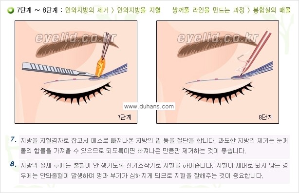 [두한성형외과 성형 FOCUS] - [퀵쌍꺼풀 수술 ③] 관련 이미지 9