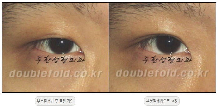 [두한성형외과 쌍커풀재수술] - [풀린 쌍커풀라인 교정] 관련 이미지 12