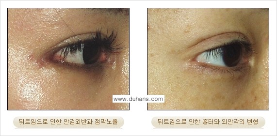[두한성형외과 경쟁력 눈성형] - [뒤트임 수술 부작용 안내] 관련 이미지 10