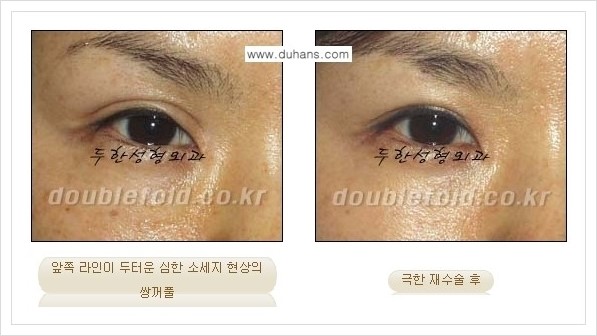 [두한성형외과 경쟁력 쌍꺼풀 재수술] - [극한의 상태에서 쌍꺼풀 재수술 안내 ①] 관련 이미지 5