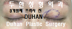 [DuHan Plastic Surgery Double Eyelid Surgery] - [Frequently Asked Questions and Answers About Eye Plastic Surgery] image 15