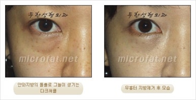 두한성형외과 눈밑수술 - 다크서클 수술 전후 관리 안내 관련 이미지 51