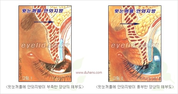 [두한성형외과 경쟁력 안검성형] - [꺼진 눈꺼풀, 눈꺼풀 함몰, 윗눈꺼풀 미세지방이식] 관련 이미지 3