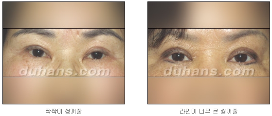 Candidates for Double Eyelid Revision Surgery: Unattractive Double Eyelids, Beautiful Double Eyelids image 2