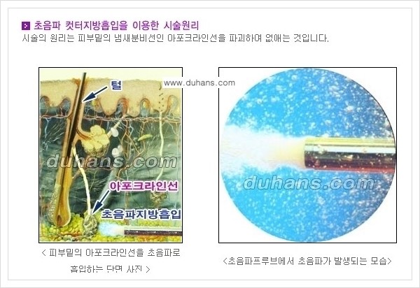 [두한성형외과 성형 FOCUS 지방흡입] - [액취증 - 다한증 초음파 컷터 지방흡입 ①] 관련 이미지 8