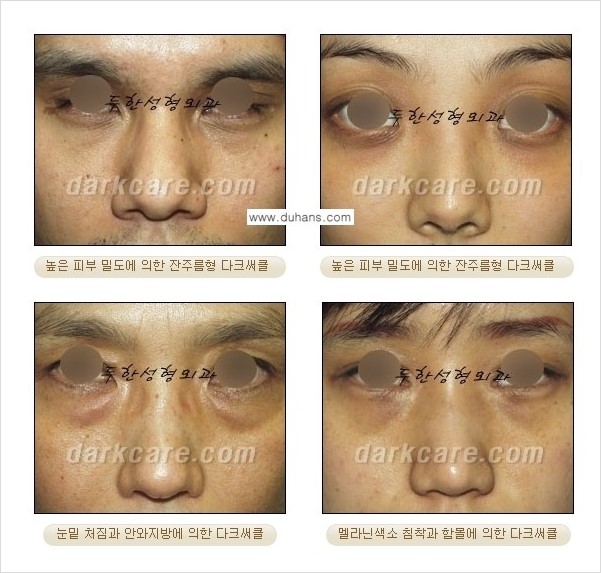 [두한성형외과 경쟁력 다크써클 교정] - [젊어 보이면서 개선된 인상을 주는 하안검 성형술] 관련 이미지 3