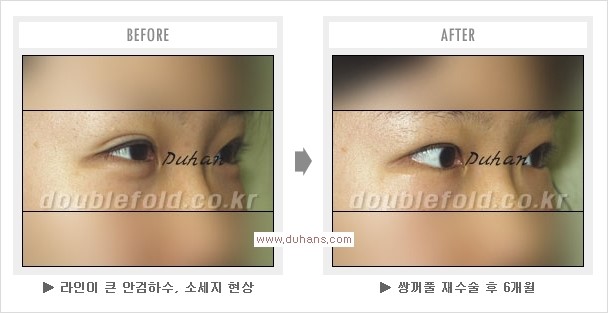 [두한성형외과 경쟁력 쌍꺼풀 재수술, 극한 눈재수술] - [두툼한 소세지 쌍꺼풀 라인 교정] 관련 이미지 16