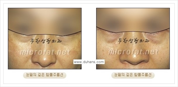 [두한성형외과 경쟁력 눈밑성형] - [눈밑 다크써클, 눈밑 주름의 교정 안내 1.] 관련 이미지 5