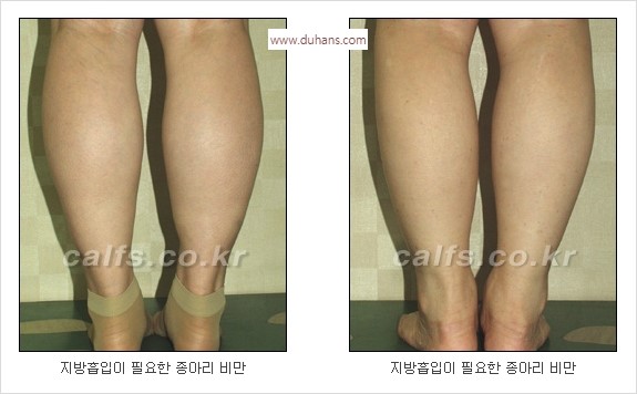 [두한성형외과 경쟁력 멀티종아리성형] - [지방흡입이 필요한 종아리 비만 안내] 관련 이미지 1