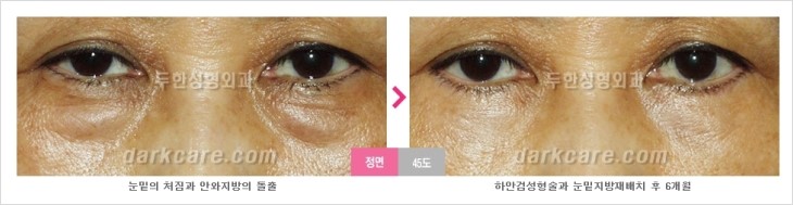 ​[두한성형외과 경쟁력 눈밑성형 리더] - [눈밑 다크써클의 증상, 원인, 종류, 치료방법 안내] 관련 이미지 61