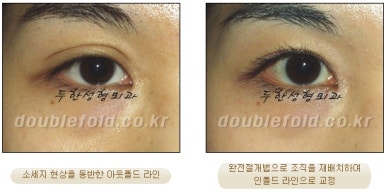 [두한성형외과 쌍커풀재수술] - [심한 소세지눈, 두줄따기, 쌍꺼풀 흉터] 관련 이미지 24