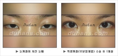 Best Place for Double Eyelid Revision Surgery, Duhan Plastic Surgery - Partial Incision Eye Revision Surgery image 12