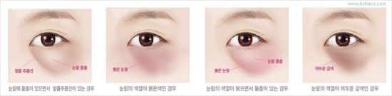 ​﻿[두한성형외과 경쟁력 눈밑성형] - [눈밑 다크써클 개선 방법] 관련 이미지 8