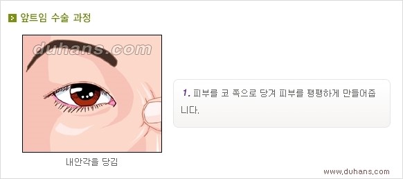 [두한성형외과 경쟁력 눈성형] - [흉터없는 몽고주름 제거 - 앞트임 수술 안내] 관련 이미지 9