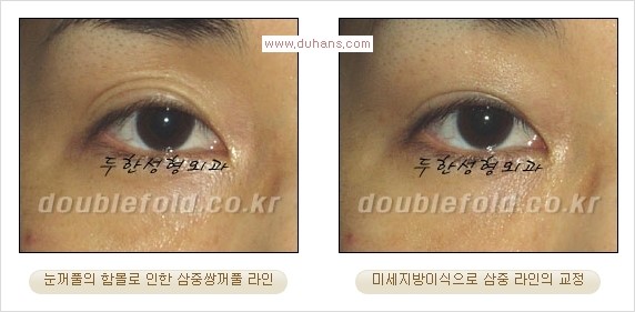 [두한성형외과 경쟁력 쌍꺼풀 재수술] - [삼중(세겹) 쌍꺼풀 라인, 눈꺼풀이 함몰된 삼중(세겹) 쌍꺼풀 라인 교정] 관련 이미지 14