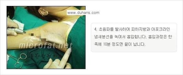 [두한성형외과 경쟁력 액취증, 다한증 치료] - [겨드랑이의 참기 힘든 냄새와 땀 치료 - 초음파 컷터지방흡입 + 리포셋 소파흡입술] 관련 이미지 17