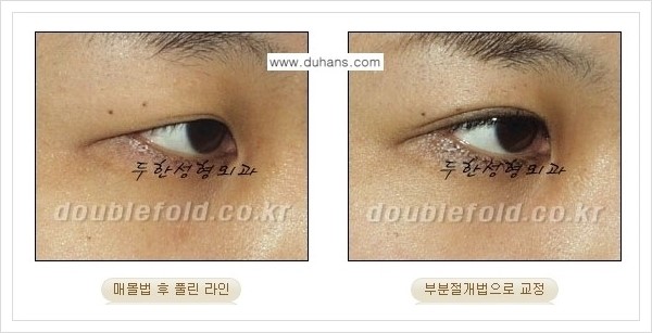 [두한성형외과 경쟁력 쌍꺼풀 재수술(극한 재수술)] - [라인이 풀렸을 경우의 쌍꺼풀 재수술 안내 ②] 관련 이미지 3