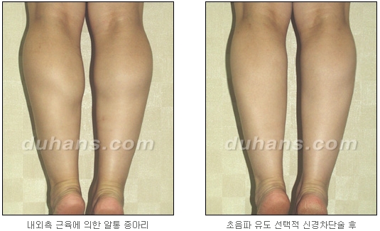 [Duhan Plastic Surgery Calf Reduction] - [How to Get Rid of Calf Muscle Bulges] image 29