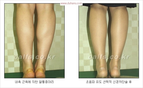 [두한성형외과 경쟁력 종아리성형 리더] - [종아리성형 실패의 원인과 원인에 따른 적합한 시술 방법] 관련 이미지 9
