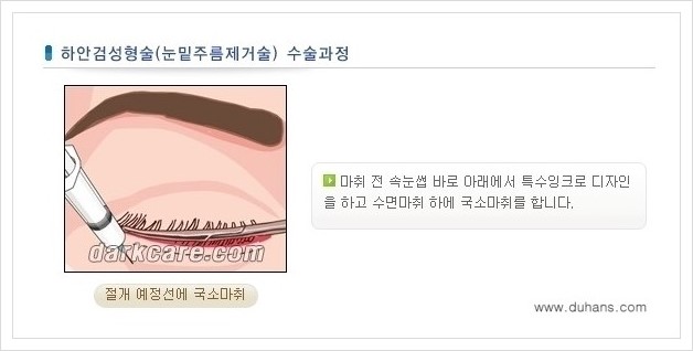 [두한성형외과 경쟁력 다크써클 치료] - [하안검 성형과 눈밑지방 재배치 안내] 관련 이미지 3