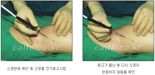[두한성형외과 종아리퇴축술] - [NO절개! 초음파유도신경차단술] 관련 이미지 15