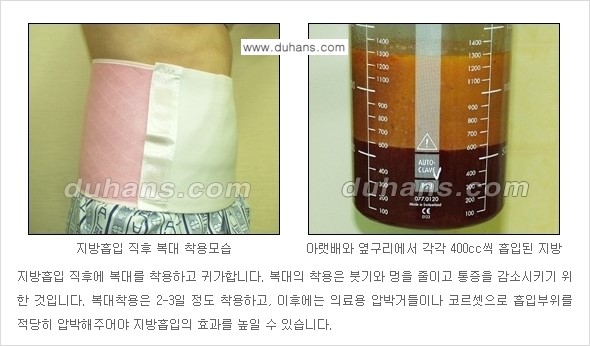 [두한성형외과 경쟁력 간편지방흡입] - [복부(뱃살) 비만 간편지방흡입] 관련 이미지 11