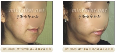 Facial Fat Liposuction at Duhan Plastic Surgery - Cheek Fat Liposuction, Jawline Liposuction, Under-Eye Fat Liposuction image 3