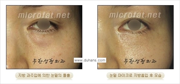 [두한성형외과 경쟁력 미세지방흡입] - [안면부의 안전한 미세지방흡입 안내] 관련 이미지 26